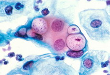 800px-Pap_smear_showing_clamydia_in_the_vacuoles_500x_HE